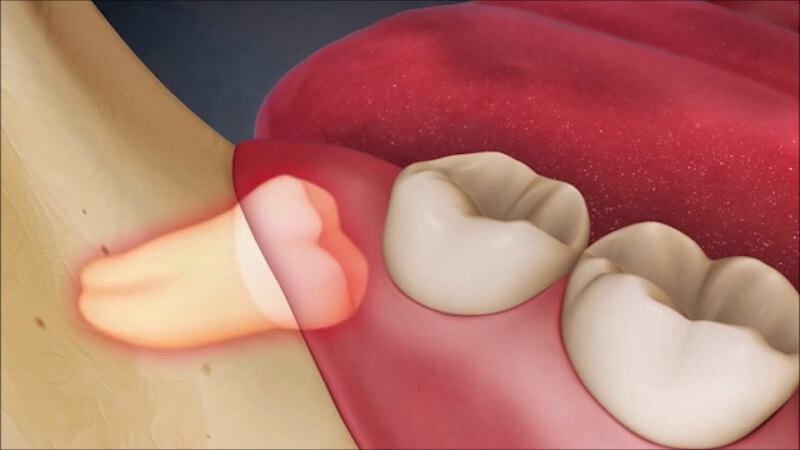 Nên nhổ răng số 8 khi răng gây ảnh hưởng không tốt đến sức khỏe