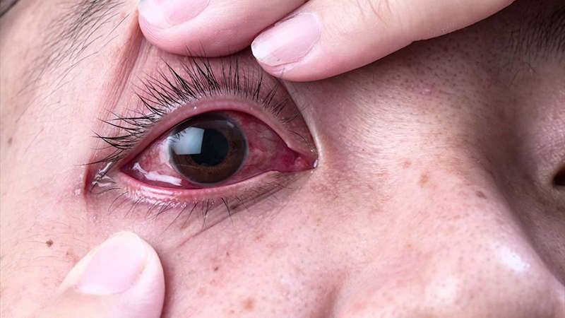 Khi đau mắt đỏ, bệnh nhân cần kiêng nhiều thực phẩm khác nhau